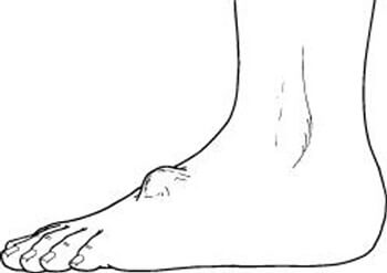 ganglion